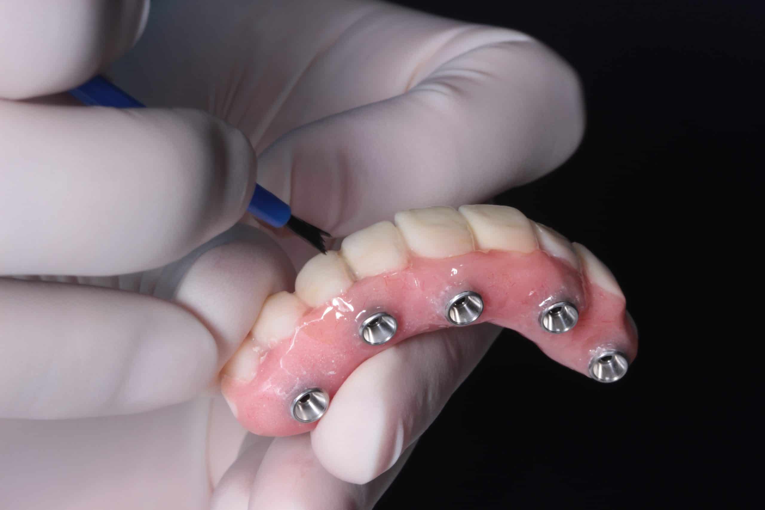Featured image for “Implant Supported Dentures”
