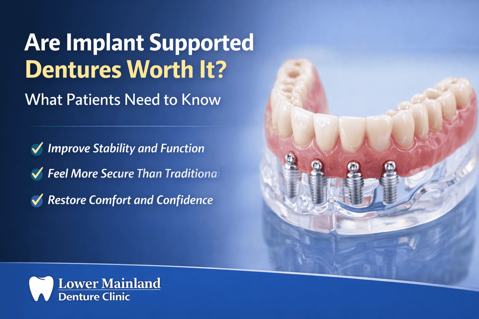 Featured image for “Are Implant Supported Dentures Worth It? What Patients Need to Know”